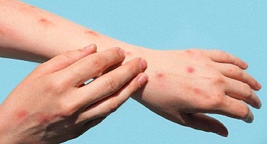 Türkiye’de maymun çiçeği vakaları yükseldi